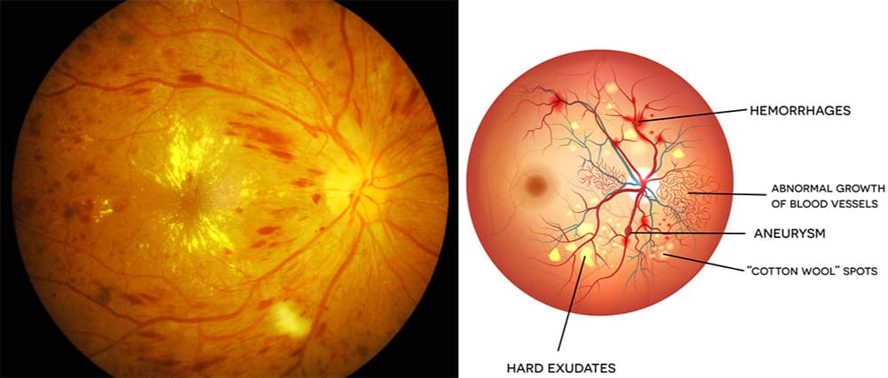 Diabetic Eye Exam