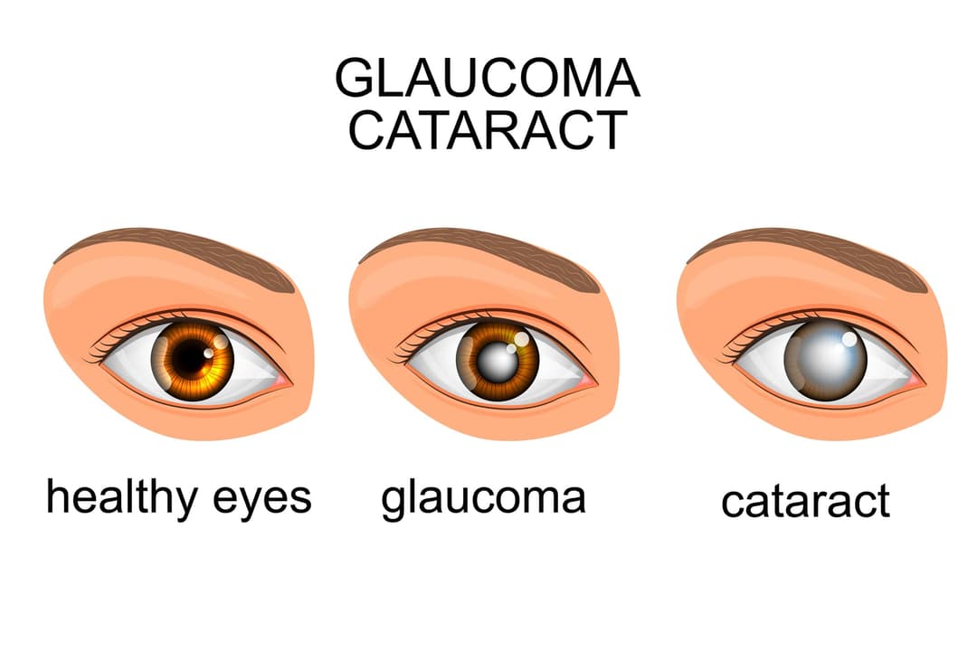 Glaucoma and Cataract Eye Exam