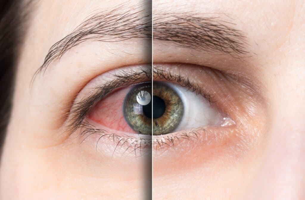 Dry Eye Treatment