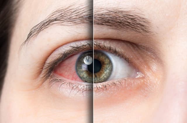 Dry Eye Treatment